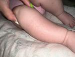 Мелкая Сыпь на ногах у новорожденного фото 3