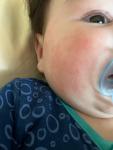 Аллергия у ребёнка в 4 месяца фото 1
