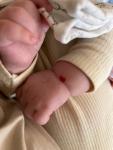 Красное выпуклое пятно на руке у ребенка фото 1