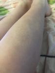 Белые пятна на ногах от солярия, пигментация фото 2