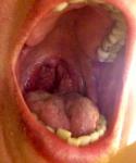 Увеличение левой миндалины, постоянное скопление слизи в горле фото 1