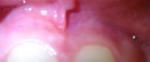 Белое выпуклое пятно над передним зубом фото 2