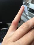 Сыпь на пальце руки с отеком фото 1