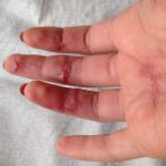 Травма сухожилия глубокого сгибателя, не разгибается палец фото 1