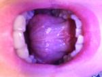 Воспаление уздечки под языком фото 1