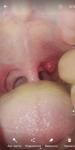 Красное горло, шишка на миндалине, болит фото 1