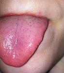 Жжение языка и сыпь фото 1