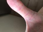 Трещины на пальцах рук, желтые уплотнения фото 3