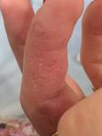 Пузырьки на безымянном пальце руки фото 1