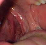 Ком в горле и увеличены лимфатические узлы за ушами фото 2