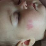 Красное пятно с уплотнением на лице у ребенка фото 2