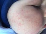 Папулезный высыпания на щеках ребёнка 8 месяцев фото 2