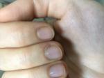 Пожелтение пальцев вокруг ногтя фото 1