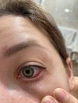 Красные глаза без симптомов фото 1