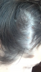 Образования в волосистой части головы фото 1