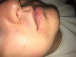 Болячка ниже губы фото 2