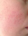 Косметика при сухой аллергической коже фото 1