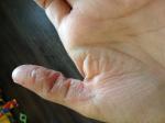 Шелушение большого и среднего пальцев руки, трещины фото 1