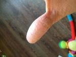 Шелушение большого и среднего пальцев руки, трещины фото 3
