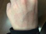 Кольцевидные пятна на коже рук и ног фото 5