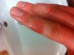 Появилась большая водянистая болячка на пальце, помогите вылечить фото 2