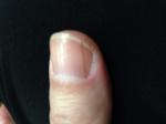 Продольная полоса темного цвета на ногте большого пальца руки фото 1