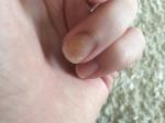Заболевание ногтевой пластины фото 1