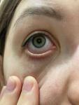 Красные глаза без симптомов фото 2