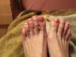 Белые пятна на ногтях(на ногах) фото 1