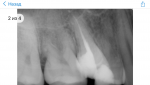 Ноет депульпированый зуб фото 1