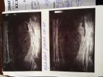 Установлен диагноз эутероидный многоузловой зоб в правой доле фото 2