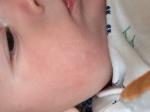 Покраснения на лице, складке под коленями у грудного ребенка фото 1