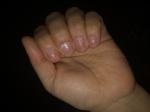 Грибок ногтей рук фото 1