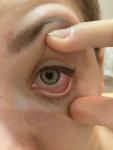 Красные глаза без симптомов фото 3