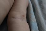 Красное пятно на руке у ребёнка, неизвестный дерматит фото 2