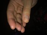 Грибок ногтей рук фото 4