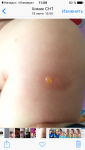Бугристое пятно у ребёнка, иногда на нём вскакивают вулдыри фото 3