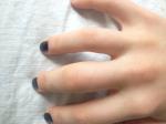 Травма среднего пальца руки фото 3