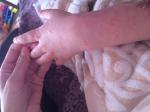 Сыпь на теле в виде мелких прыщиков у ребенка фото 1