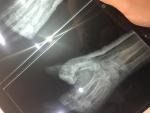 Перелом большого пальца руки фото 2