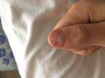 Грибок ногтевой пластины фото 1