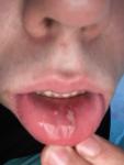Рассечение губы с внутренней стороны фото 1