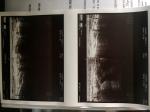 Ноющая боль в левом колене (с внутренней стороны) фото 1