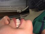 Ассиметрия лица, неправильный прикус, удаление зуба мудрости фото 2