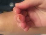 Болезненное уплотнение возле ногтя на пальце руки фото 1