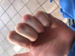 Покраснение пальцев на сгибе фото 2