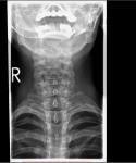Рентген шеи, чувство удушья и инородного тела фото 1