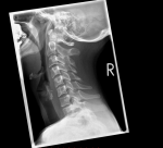 Рентген шеи, чувство удушья и инородного тела фото 2