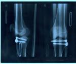 Тугоподвижность коленного сустава после перелома мыщелок фото 1