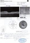 Вторичная макулодистрофия, посттравмотический хориоретинальный рубец ОД фото 2